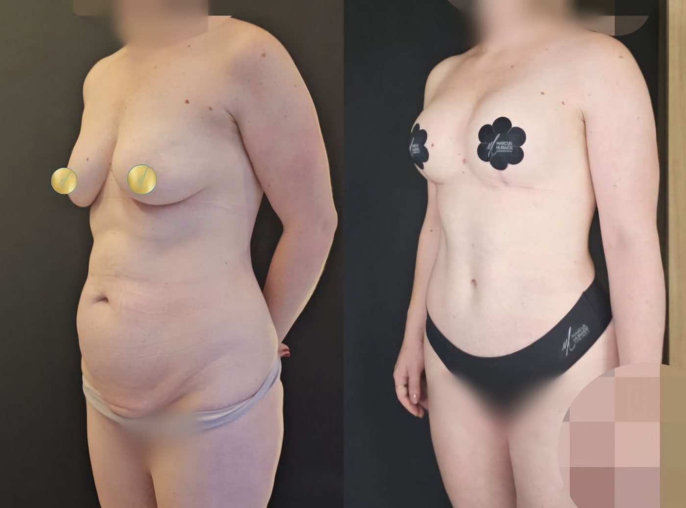 Antes e depois · Abdominoplastia + Mastopexia com implantes