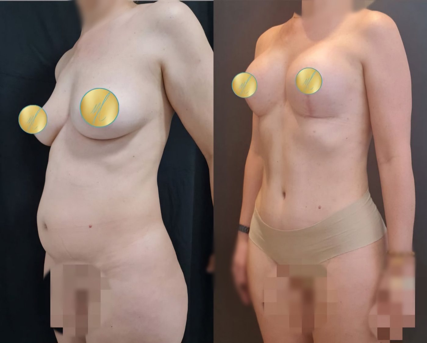 Antes e depois · Abdominoplastia + Mastopexia com implantes