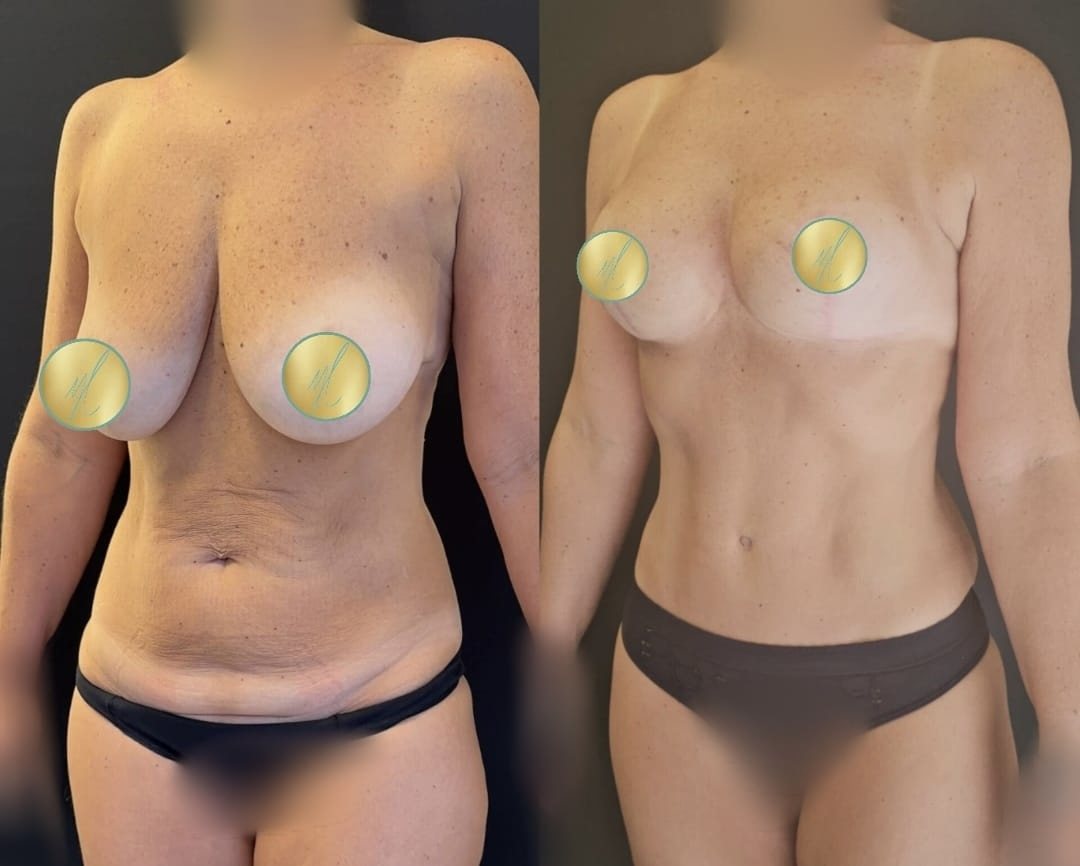 Antes e depois · Abdominoplastia + Mastopexia com implantes