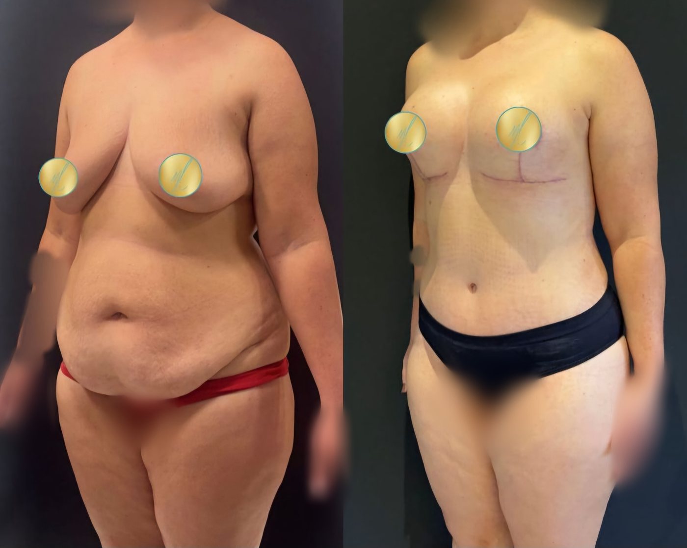 Antes e depois · Abdominoplastia + Mastopexia com implantes