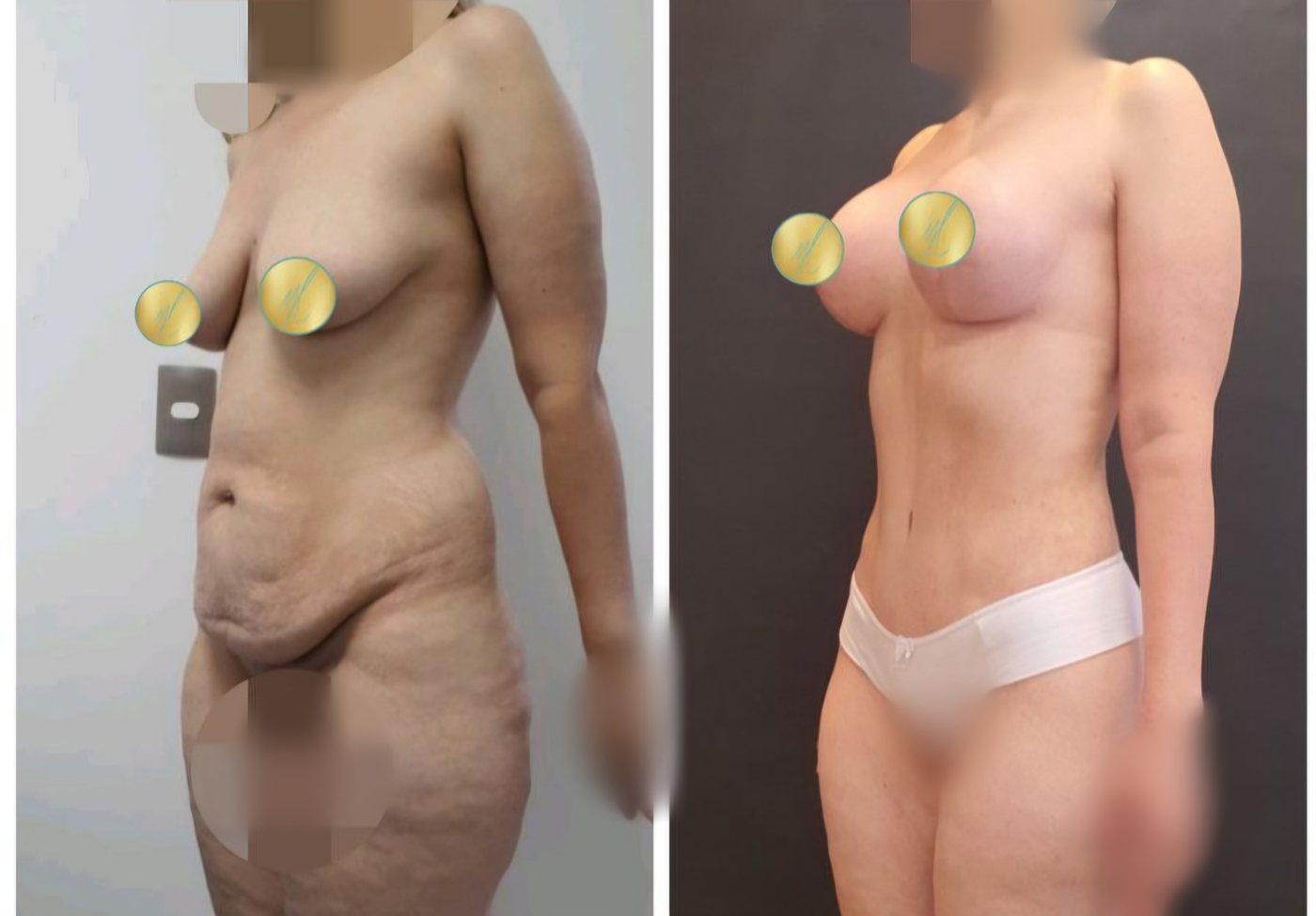 Antes e depois · Abdominoplastia + Mastopexia com implantes