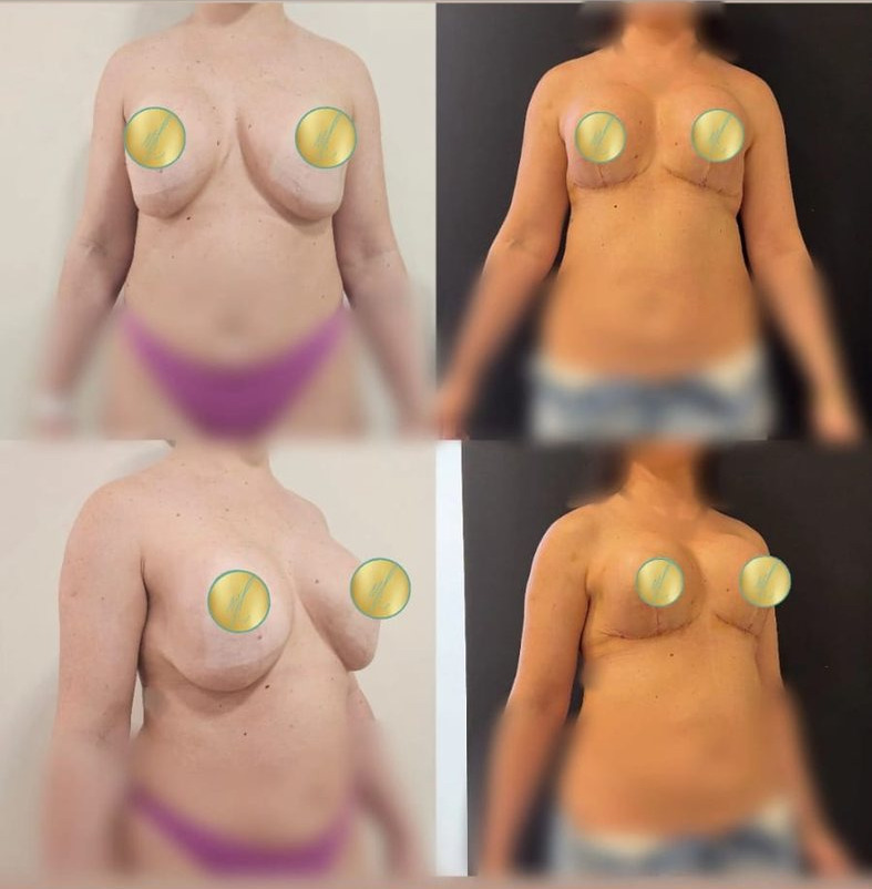 Mamoplastia complexa / secundária