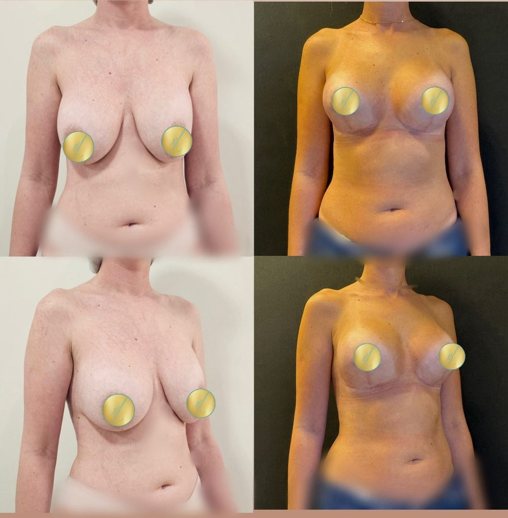 Antes e depois · Mamoplastias complexas e secundárias