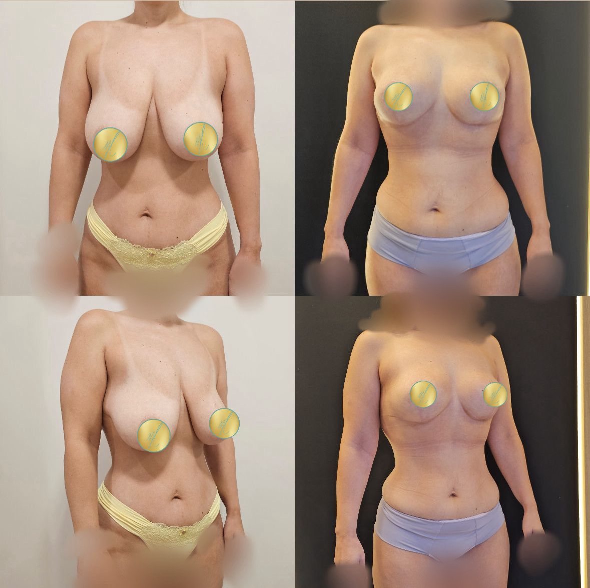 Mamoplastia Redutora · Short Scar