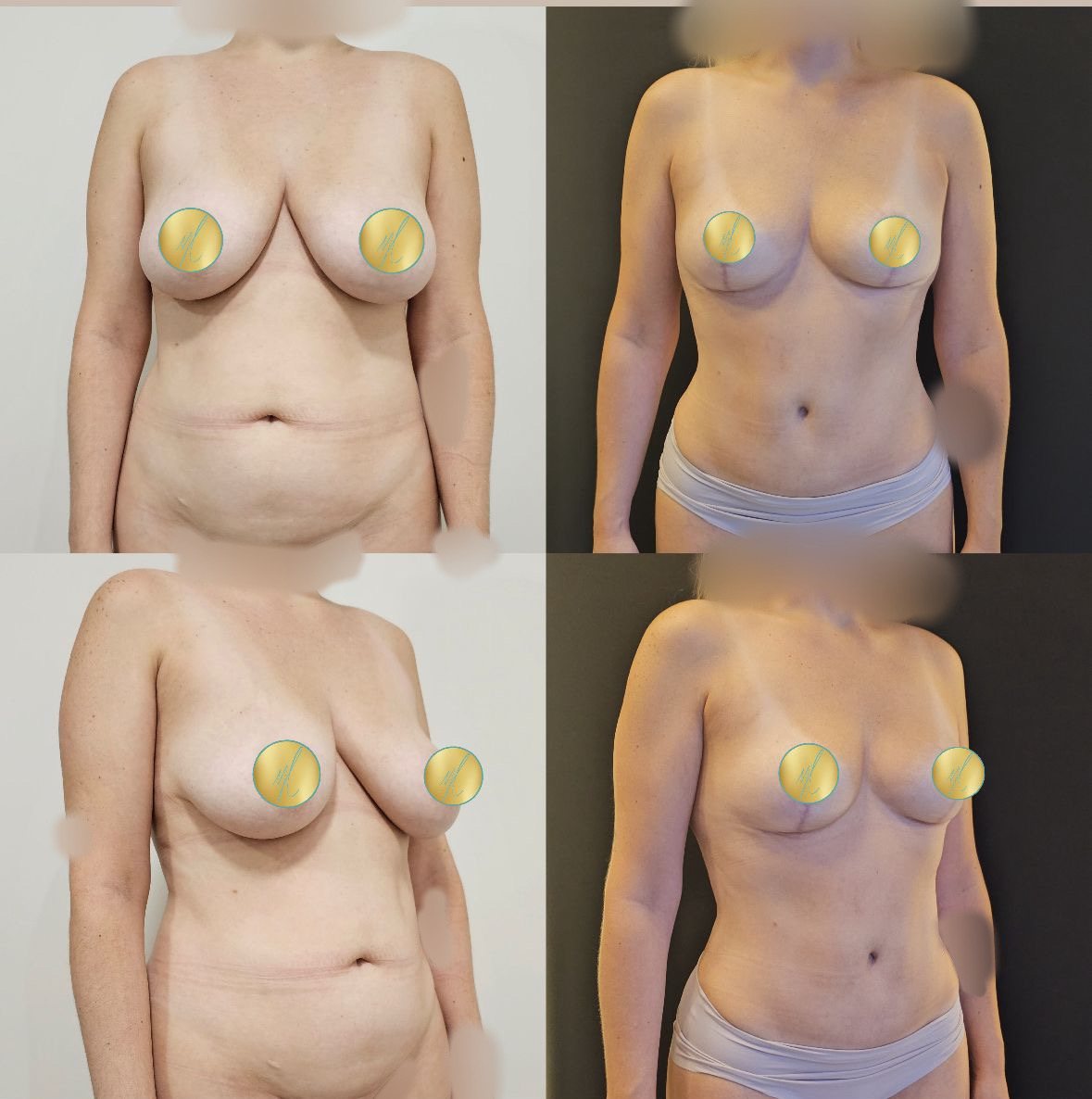 Antes e depois · Mamoplastia Redutora