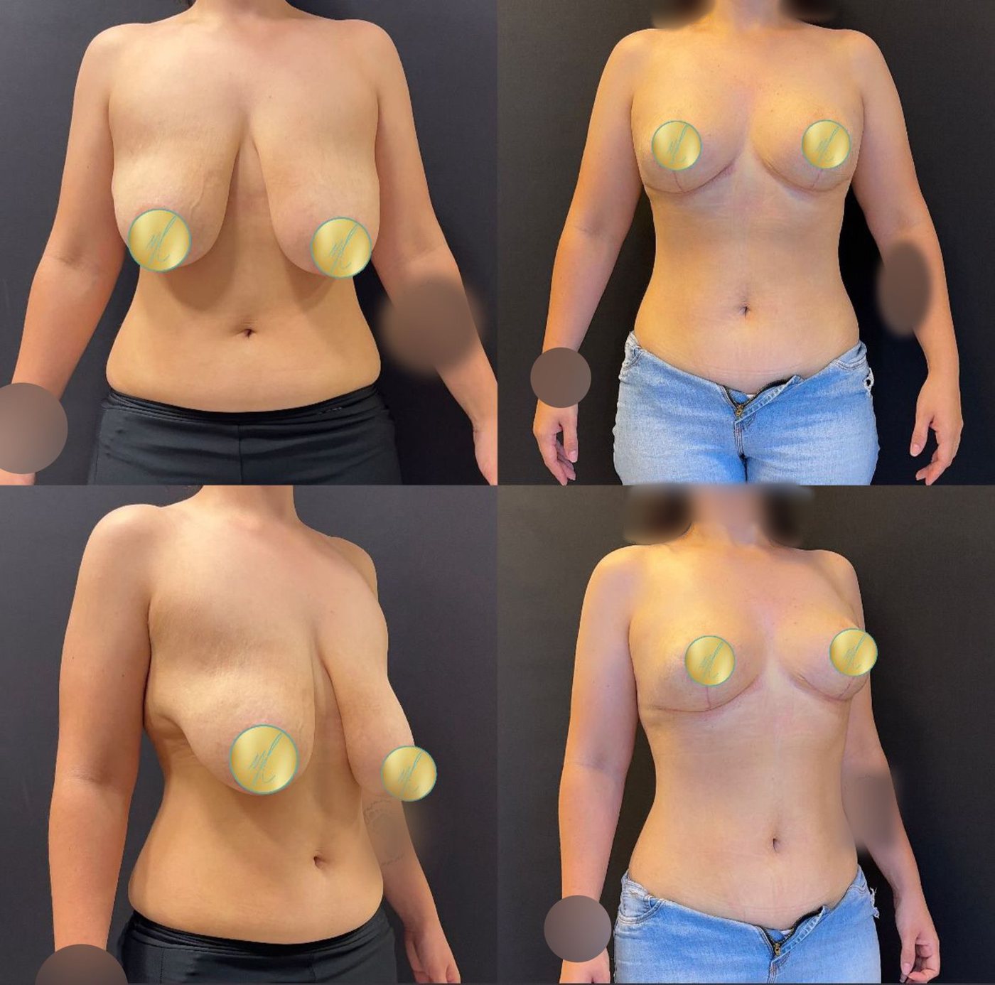 Antes e depois · Mamoplastia Redutora