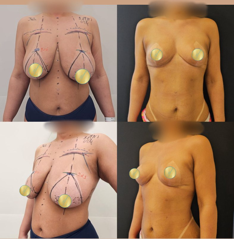 Antes e depois · Mamoplastia Redutora