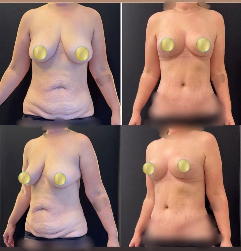 Antes e depois · Mastopexia sem implantes