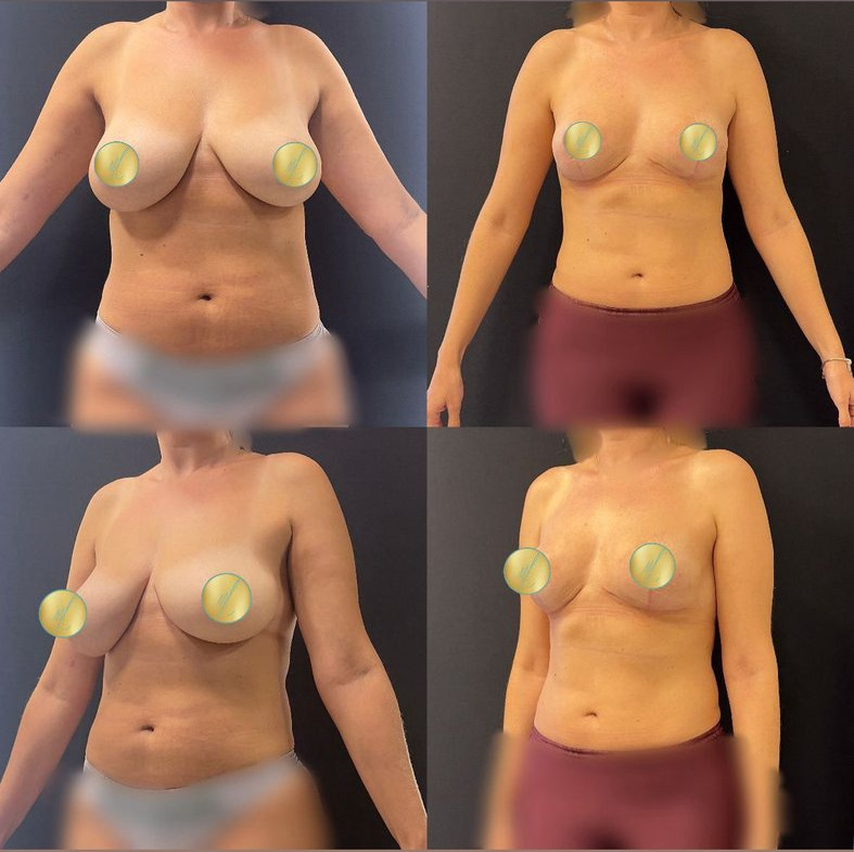 Antes e depois · Mastopexia sem implantes